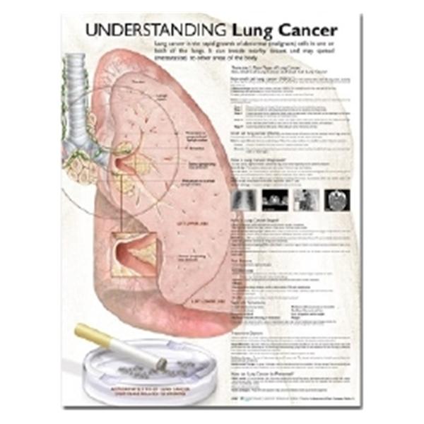 Chart Anatomical Understanding Lung Cancer English 20x26\